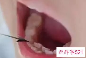 为什么孩子换牙后牙就长歪了
