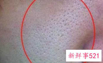 男士脸部毛孔粗大螨虫脸油
