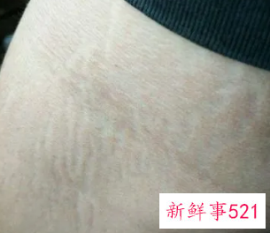 长肥胖纹的原因是皮肤病吗