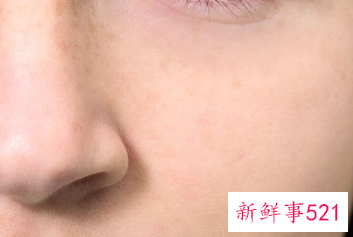 脸上的黑斑怎么能去掉