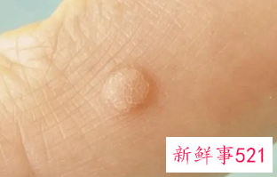 去瘊子最快的方法