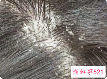 洗头后头皮有一层白色干皮