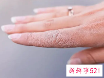 手掌皮肤粗糙角质厚硬