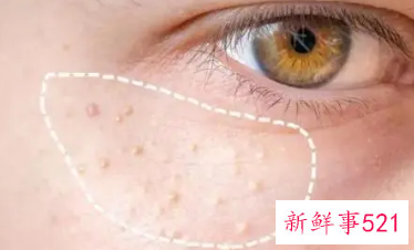 怎么祛除脸上的脂肪粒