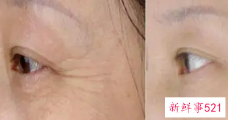 激光去除鱼尾纹有什么优势