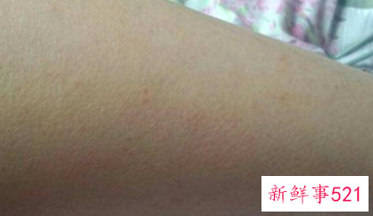 怎样改善鸡皮肤褐色斑点