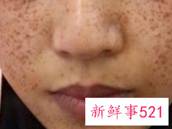 脸上长斑和黑色素怎么去除