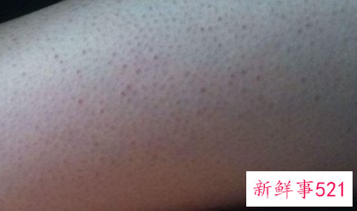 怎样改善鸡皮肤褐色斑点