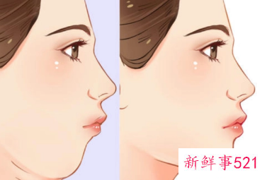 减双下巴有效的运动