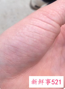 手掌皮肤粗糙角质厚硬