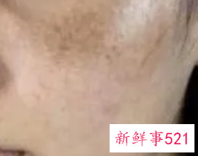 脸上长斑和黑色素怎么去除