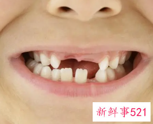 为什么孩子换牙后牙就长歪了