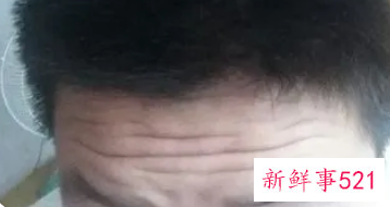 青少年有抬头纹怎么去除