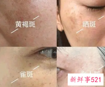 长斑了可以怎么淡化