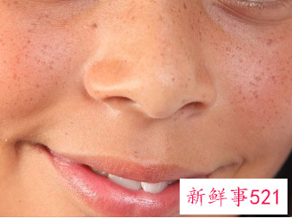 脸上的黑斑怎么能去掉