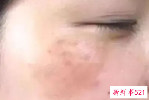 最先进的祛斑方法有哪些