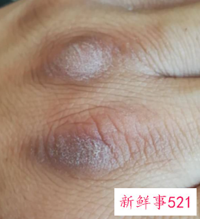 手干燥粗糙掉皮怎么办