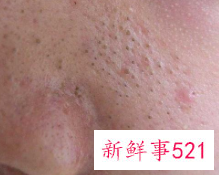 男士应该如何预防黑头