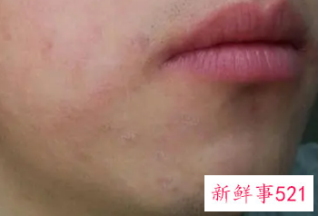 下巴紧绷干燥起皮发红