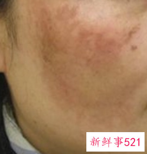 怎么去除蝴蝶斑