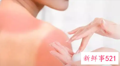 皮肤晒伤后怎么处理