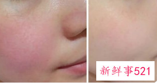 怎样自己在家修复红血丝