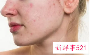 快速去痘的方法