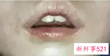 张嘴睡觉嘴唇会变厚吗