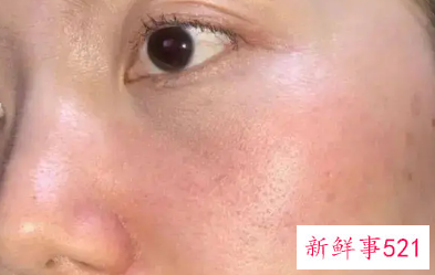 抹护肤品脸上有灼烧感