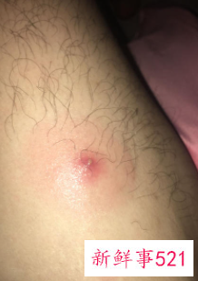 大腿长个脓包又硬又疼