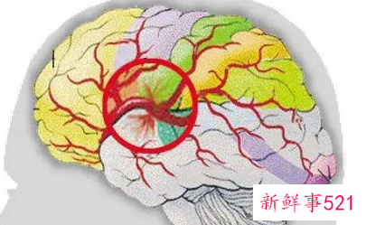 颅内出血对宝宝的影响