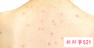 背部长痘哪里需要排毒