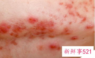 闭合性粉刺怎么治疗好得快