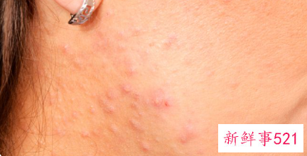 闭合性粉刺怎么治疗好得快