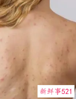 背部长痘哪里需要排毒