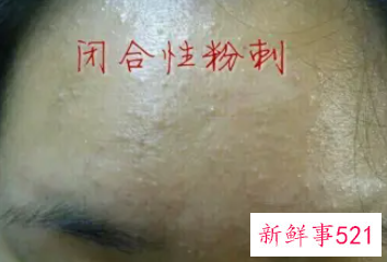 闭合性粉刺怎么治疗好得快