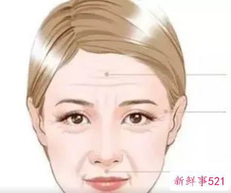 除皱针打了注意哪些问题