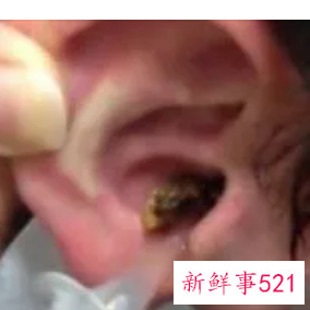 清理耳屎去医院挂什么科