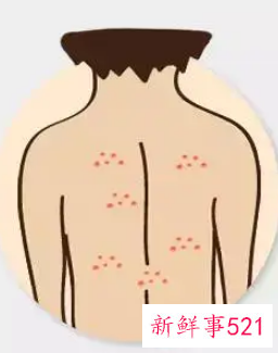 背部长痘哪里需要排毒