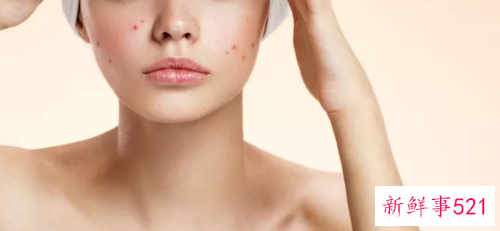 额头上长痘痘怎么消除