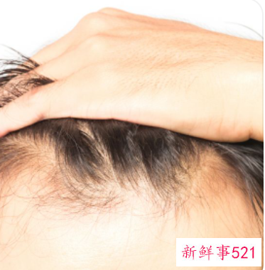 秃顶怎么办才能长头发