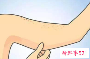 去腿上鸡皮肤有效的方法