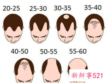 脱发的发病率