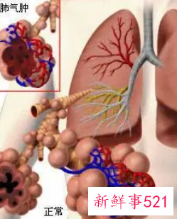 肺气肿的克星