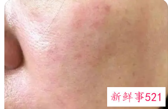 抹护肤品脸上有灼烧感