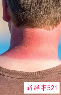 皮肤晒伤了要怎么办