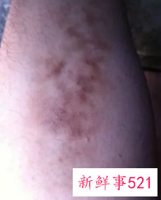 小腿黑色素斑块怎么去除