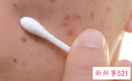 如何把男性脸上的痘痘都去除掉