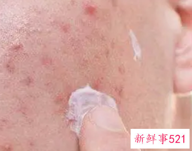 敏感肌长痘痘怎么办