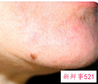 床上螨虫咬的症状